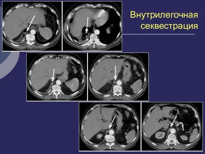 Внутрилегочная секвестрация