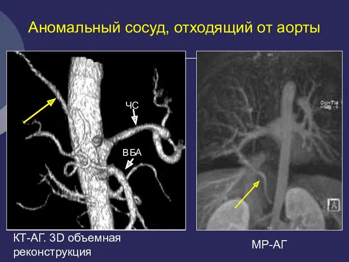 Аномальный сосуд, отходящий от аорты КТ-АГ. 3D объемная реконструкция ЧС ВБА МР-АГ