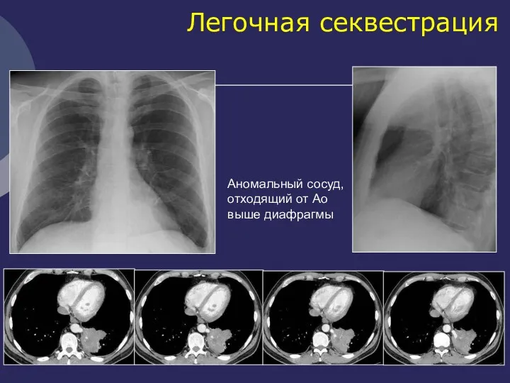 Легочная секвестрация Аномальный сосуд, отходящий от Ао выше диафрагмы