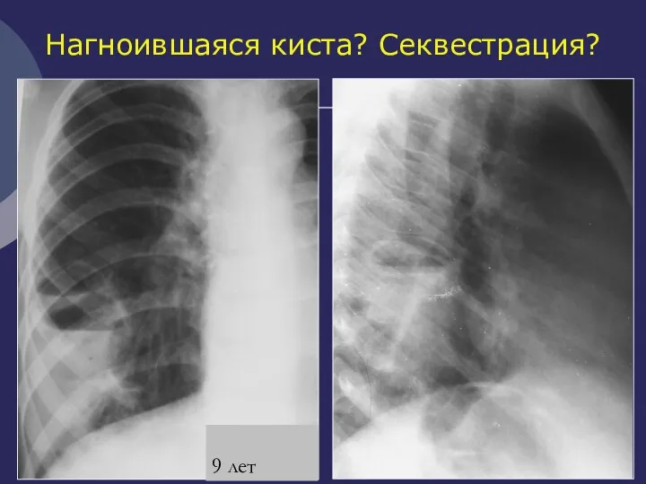 Нагноившаяся киста? Секвестрация? 9 лет