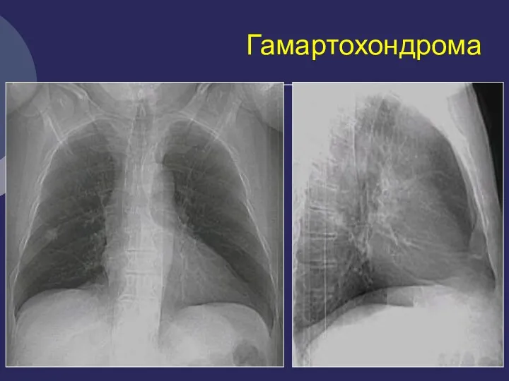 Гамартохондрома