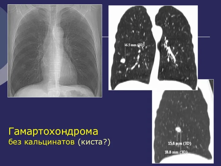 Гамартохондрома без кальцинатов (киста?)