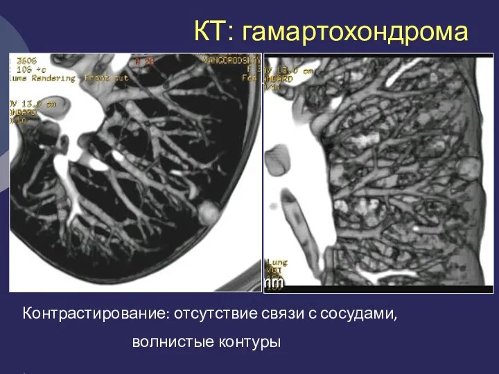 КТ: гамартохондрома Контрастирование: отсутствие связи с сосудами, волнистые контуры ,