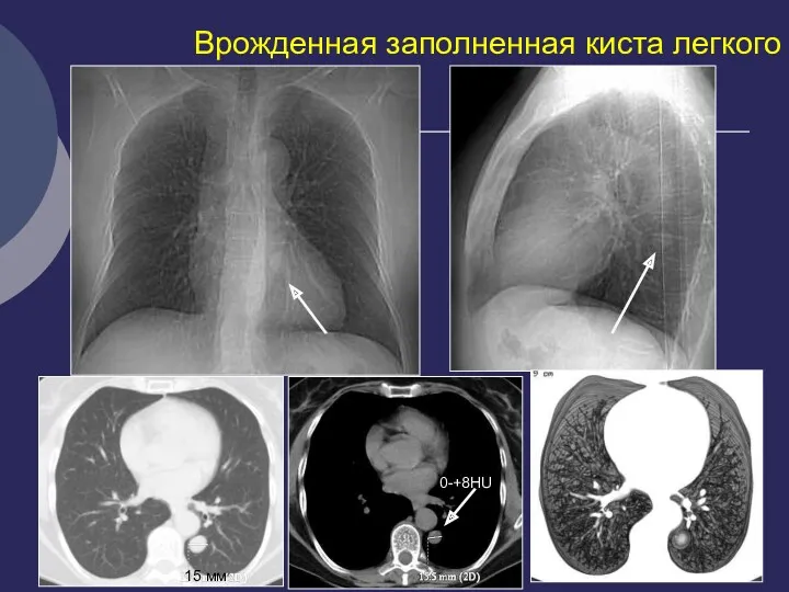 Врожденная заполненная киста легкого 15 мм 0-+8НU