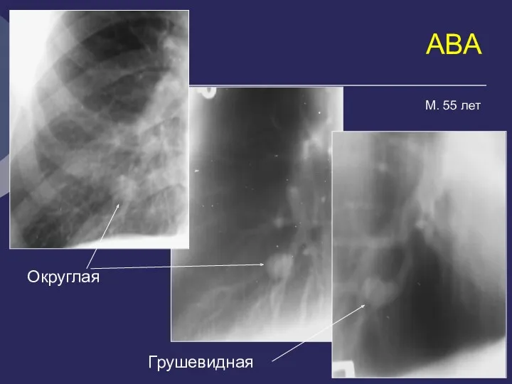 АВА Округлая Грушевидная М. 55 лет