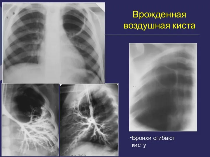 Врожденная воздушная киста Дренирующий бронх не виден Бронхи огибают кисту