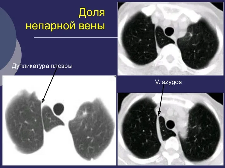 Доля непарной вены Дупликатура плевры V. azygos