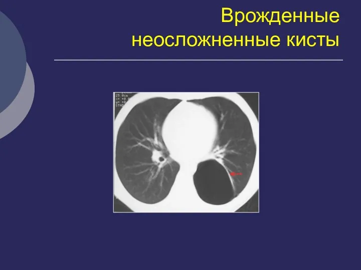 Врожденные неосложненные кисты