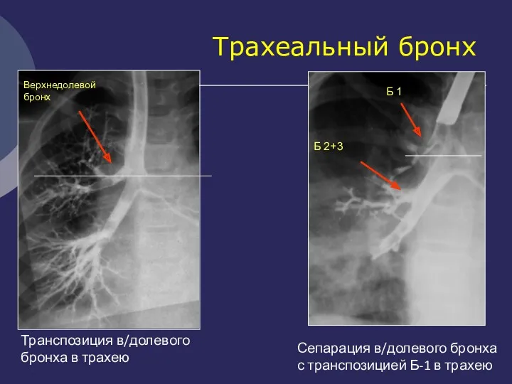 Трахеальный бронх Транспозиция в/долевого бронха в трахею Сепарация в/долевого бронха