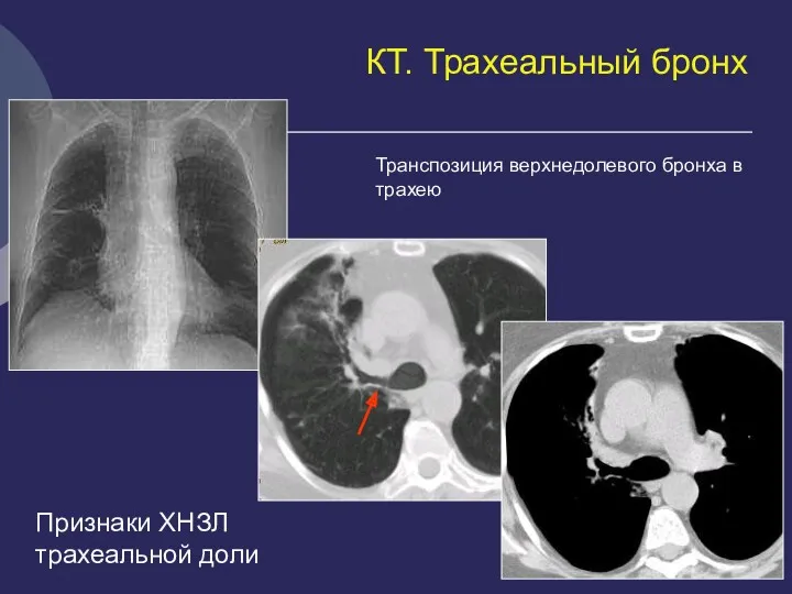 КТ. Трахеальный бронх Признаки ХНЗЛ трахеальной доли Транспозиция верхнедолевого бронха в трахею