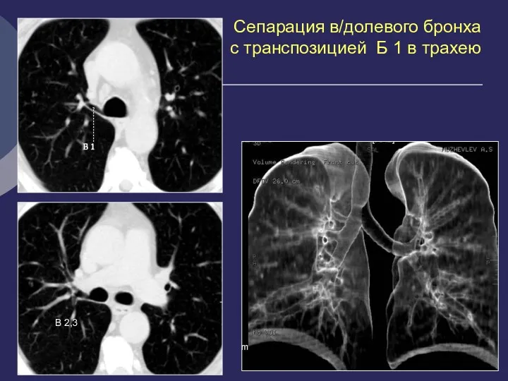 Сепарация в/долевого бронха с транспозицией Б 1 в трахею В 2,3