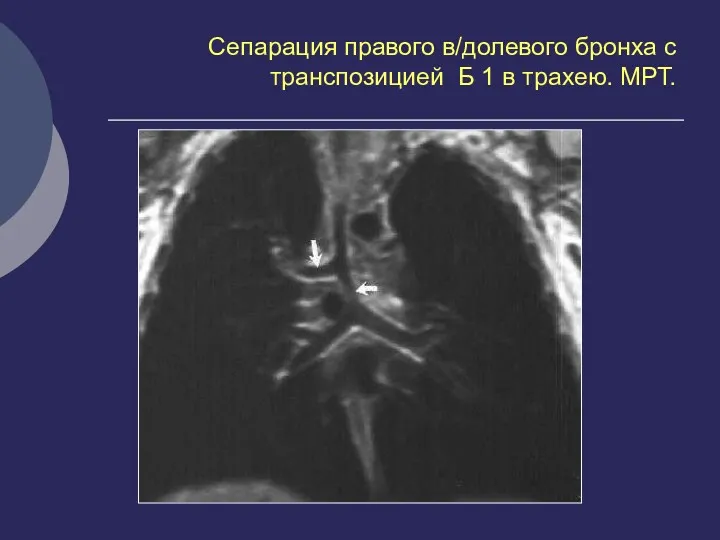 Сепарация правого в/долевого бронха с транспозицией Б 1 в трахею. МРТ.