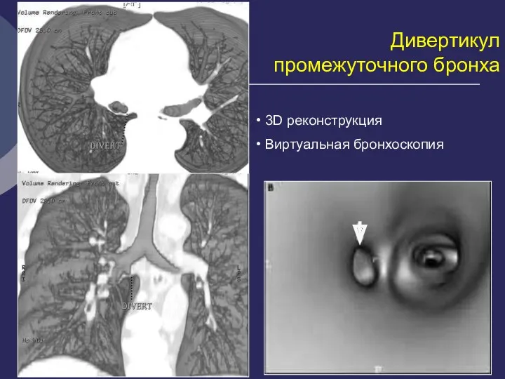 Дивертикул промежуточного бронха 3D реконструкция Виртуальная бронхоскопия