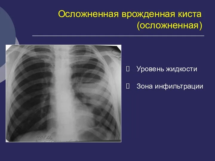 Осложненная врожденная киста (осложненная) Уровень жидкости Зона инфильтрации