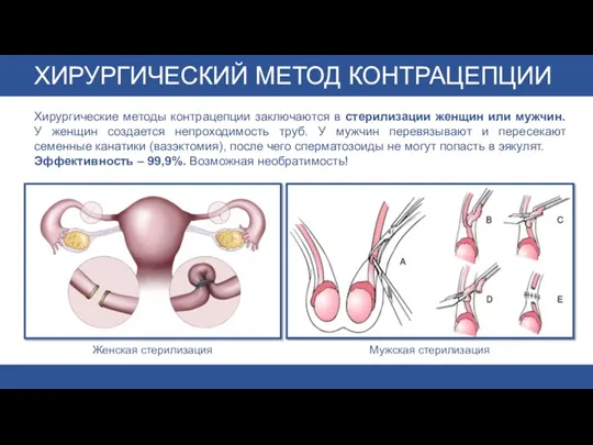 ХИРУРГИЧЕСКИЙ МЕТОД КОНТРАЦЕПЦИИ Хирургические методы контрацепции заключаются в стерилизации женщин