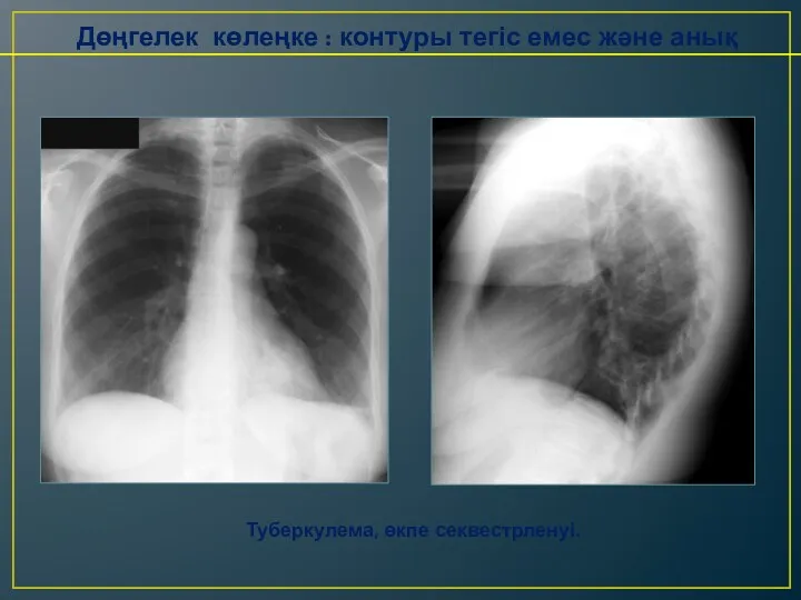 Дөңгелек көлеңке : контуры тегіс емес және анық Туберкулема, өкпе секвестрленуі.