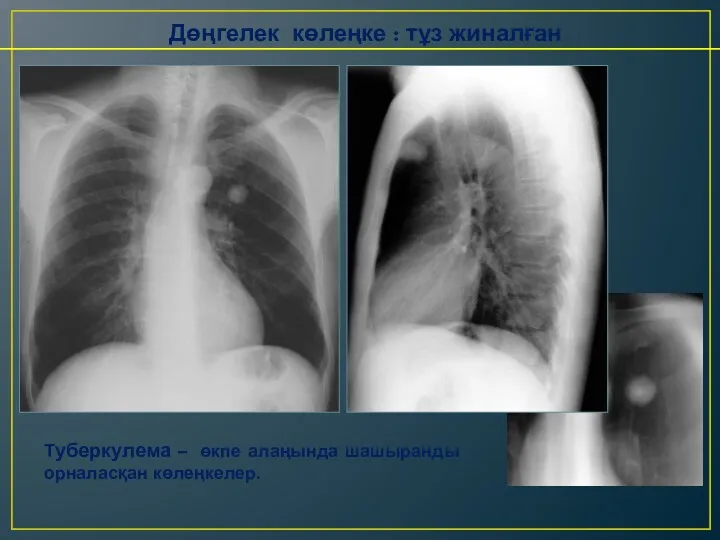 Дөңгелек көлеңке : тұз жиналған Туберкулема – өкпе алаңында шашыранды орналасқан көлеңкелер.