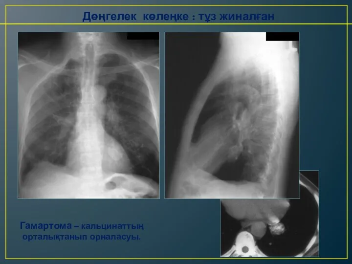 Дөңгелек көлеңке : тұз жиналған Гамартома – кальцинаттың орталықтанып орналасуы.