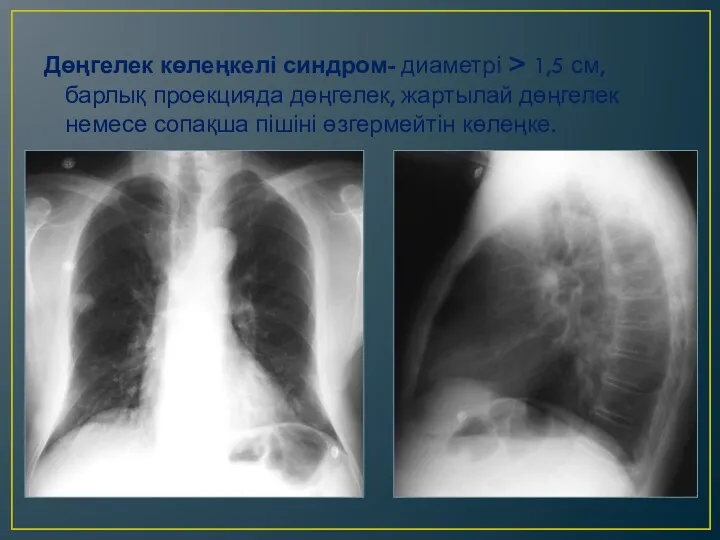 Дөңгелек көлеңкелі синдром- диаметрі > 1,5 см, барлық проекцияда дөңгелек,