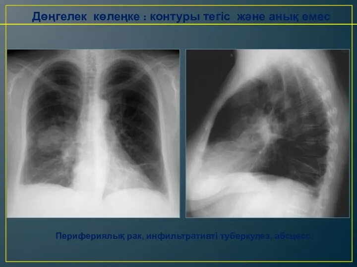 Дөңгелек көлеңке : контуры тегіс және анық емес Перифериялық рак, инфильтративті туберкулез, абсцесс.