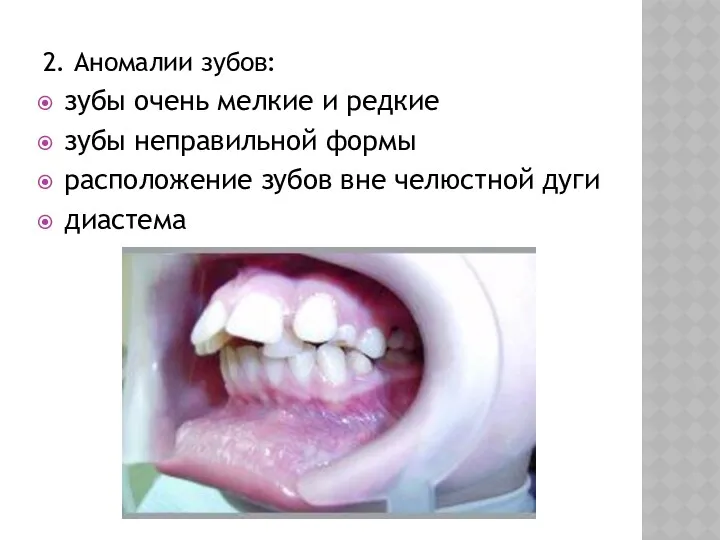2. Аномалии зубов: зубы очень мелкие и редкие зубы неправильной