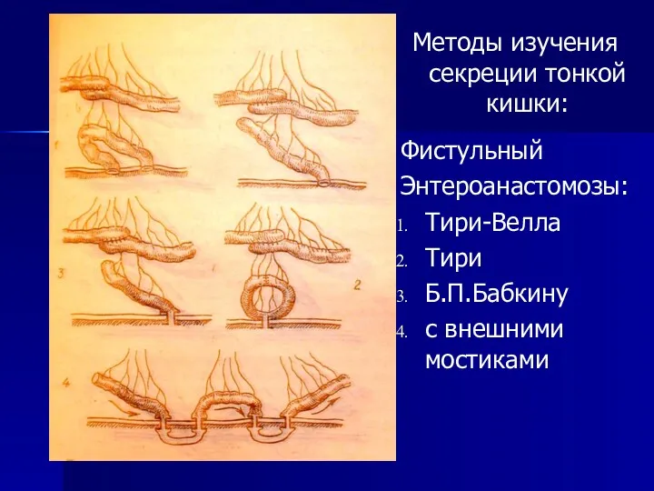 Методы изучения секреции тонкой кишки: Фистульный Энтероанастомозы: Тири-Велла Тири Б.П.Бабкину с внешними мостиками