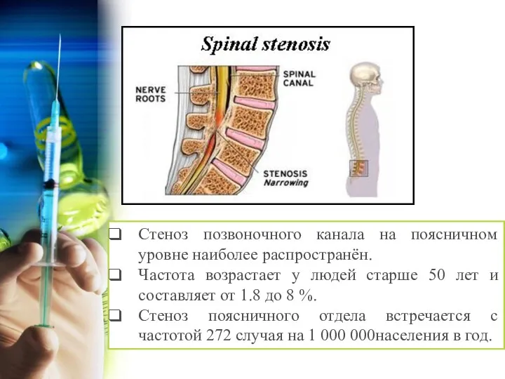 Стеноз позвоночного канала на поясничном уровне наиболее распространён. Частота возрастает