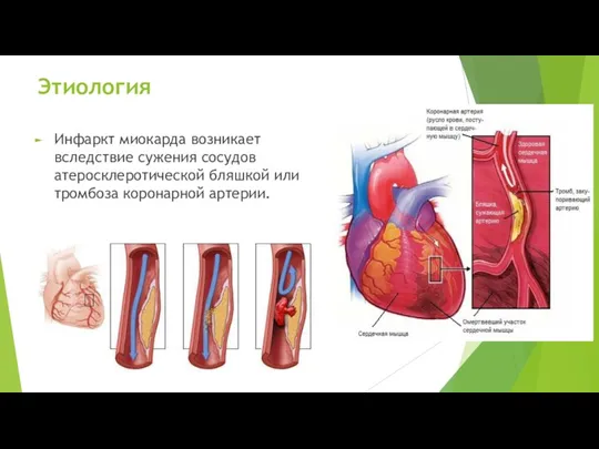 Этиология Инфаркт миокарда возникает вследствие сужения сосудов атеросклеротической бляшкой или тромбоза коронарной артерии.