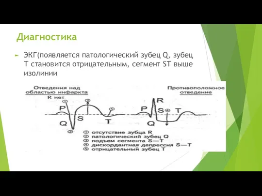 Диагностика ЭКГ(появляется патологический зубец Q, зубец Т становится отрицательным, сегмент SТ выше изолинии