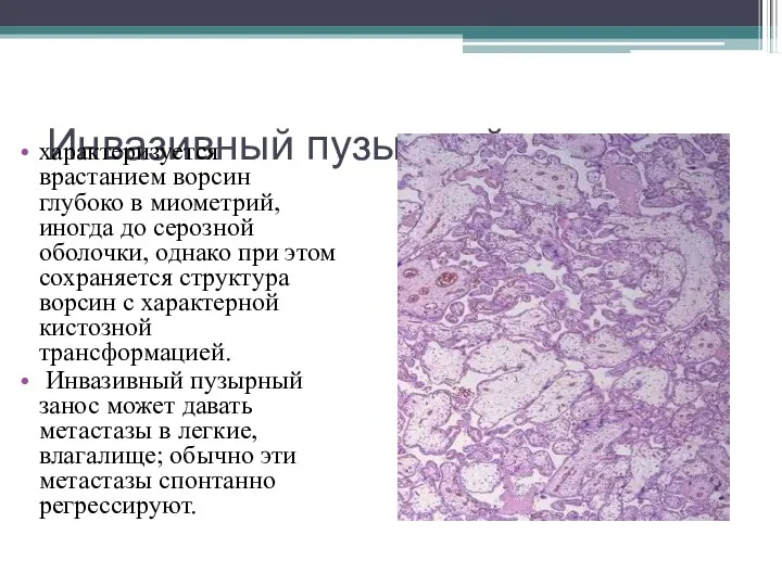 Инвазивный пузырный занос характеризуется врастанием ворсин глубоко в миометрий, иногда