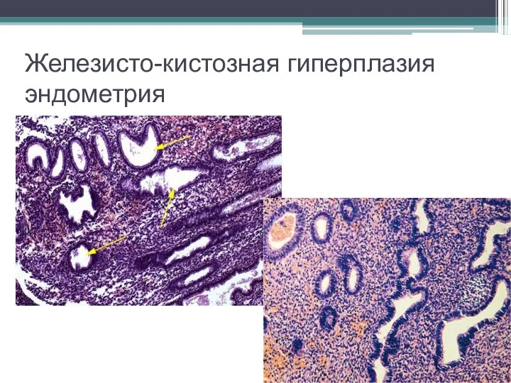 Железисто-кистозная гиперплазия эндометрия