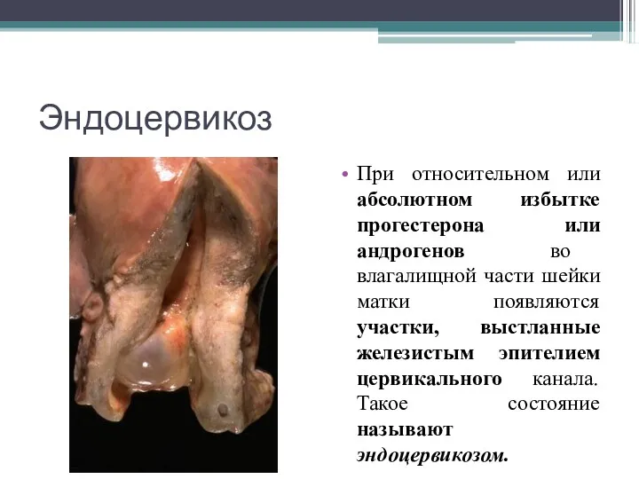 Эндоцервикоз При относительном или абсолютном избытке прогестерона или андрогенов во