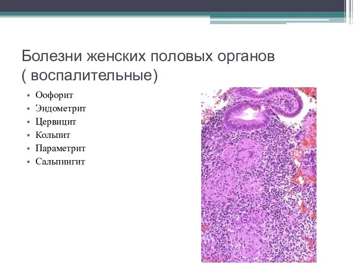 Болезни женских половых органов ( воспалительные) Оофорит Эндометрит Цервицит Кольпит Параметрит Сальпингит