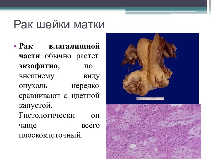 Рак шейки матки Рак влагалищной части обычно растет экзофитно, по