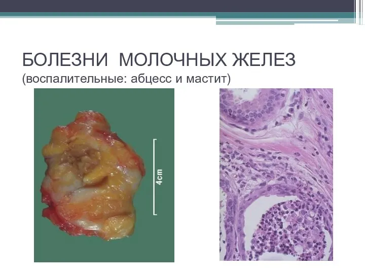 БОЛЕЗНИ МОЛОЧНЫХ ЖЕЛЕЗ (воспалительные: абцесс и мастит)