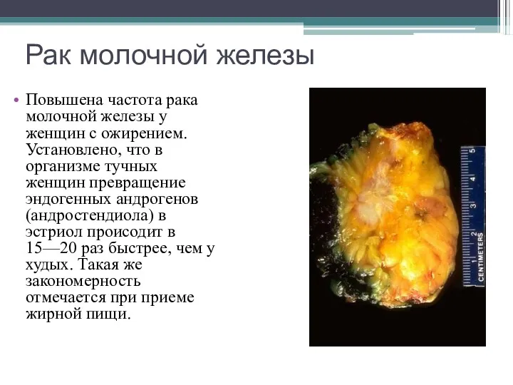 Рак молочной железы Повышена частота рака молочной железы у женщин