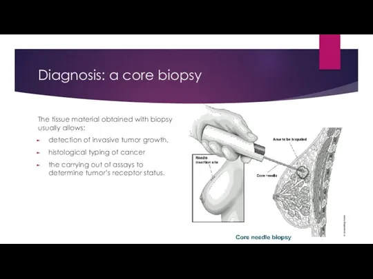 Diagnosis: a core biopsy The tissue material obtained with biopsy