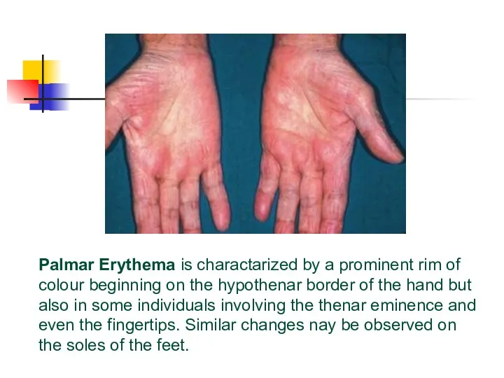 Palmar Erythema is charactarized by a prominent rim of colour