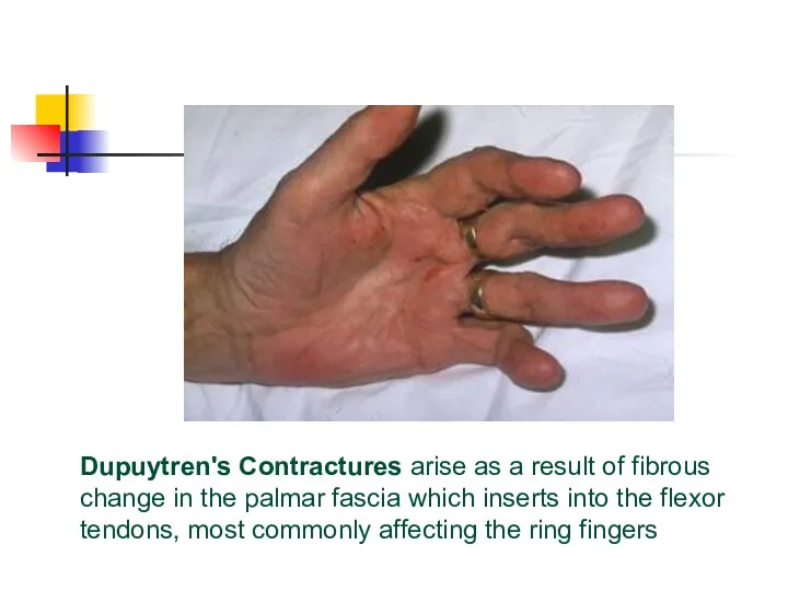 Dupuytren's Contractures arise as a result of fibrous change in