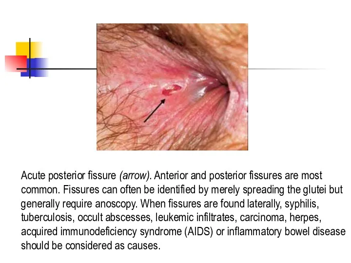 Acute posterior fissure (arrow). Anterior and posterior fissures are most