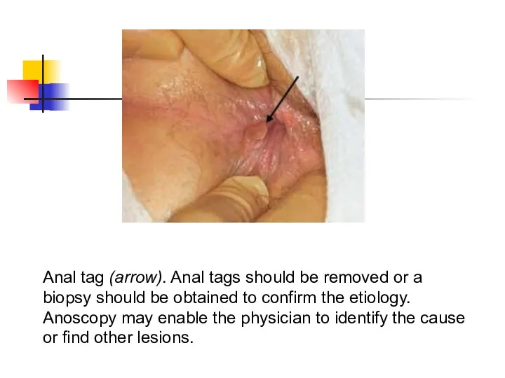 Anal tag (arrow). Anal tags should be removed or a