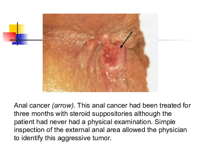Anal cancer (arrow). This anal cancer had been treated for