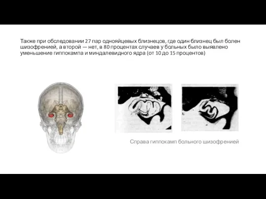 Также при обследовании 27 пар однояйцевых близнецов, где один близнец