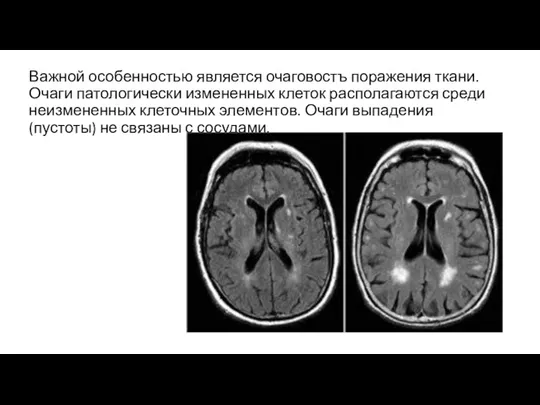 Важной особенностью является очаговостъ поражения ткани. Очаги патологически измененных клеток