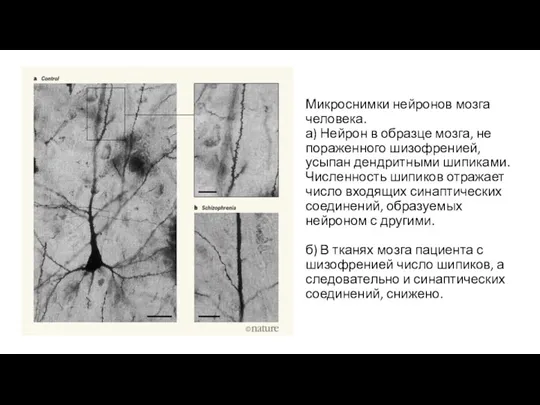 Микроснимки нейронов мозга человека. а) Нейрон в образце мозга, не