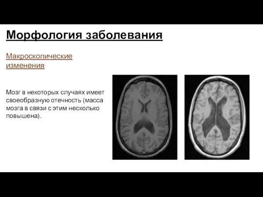 Морфология заболевания Макроскопические изменения Мозг в некоторых случаях имеет своеобразную