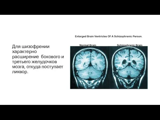 Для шизофрении характерно расширение боко­вого и третьего желудочков мозга, откуда поступает ликвор.