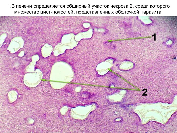 1.В печени определяется обширный участок некроза 2. среди которого множество цист-полостей, представленных оболочкой паразита.