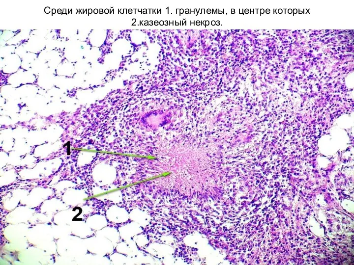 Среди жировой клетчатки 1. гранулемы, в центре которых 2.казеозный некроз.