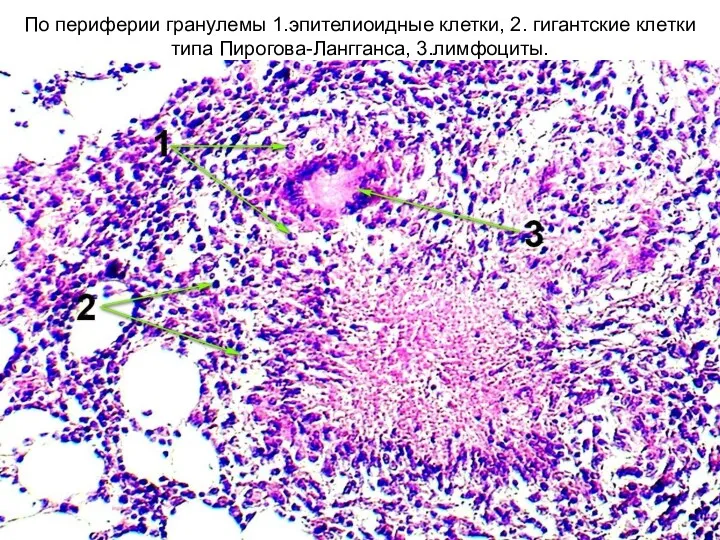По периферии гранулемы 1.эпителиоидные клетки, 2. гигантские клетки типа Пирогова-Лангганса, 3.лимфоциты.